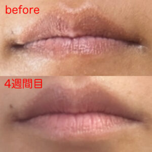 「RP芦屋」神戸芦屋でローマピンク唇アートメイクの上に35才4週間目！