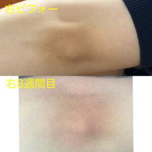 「RP芦屋」神戸芦屋でローマピンク肘再施術の症例！